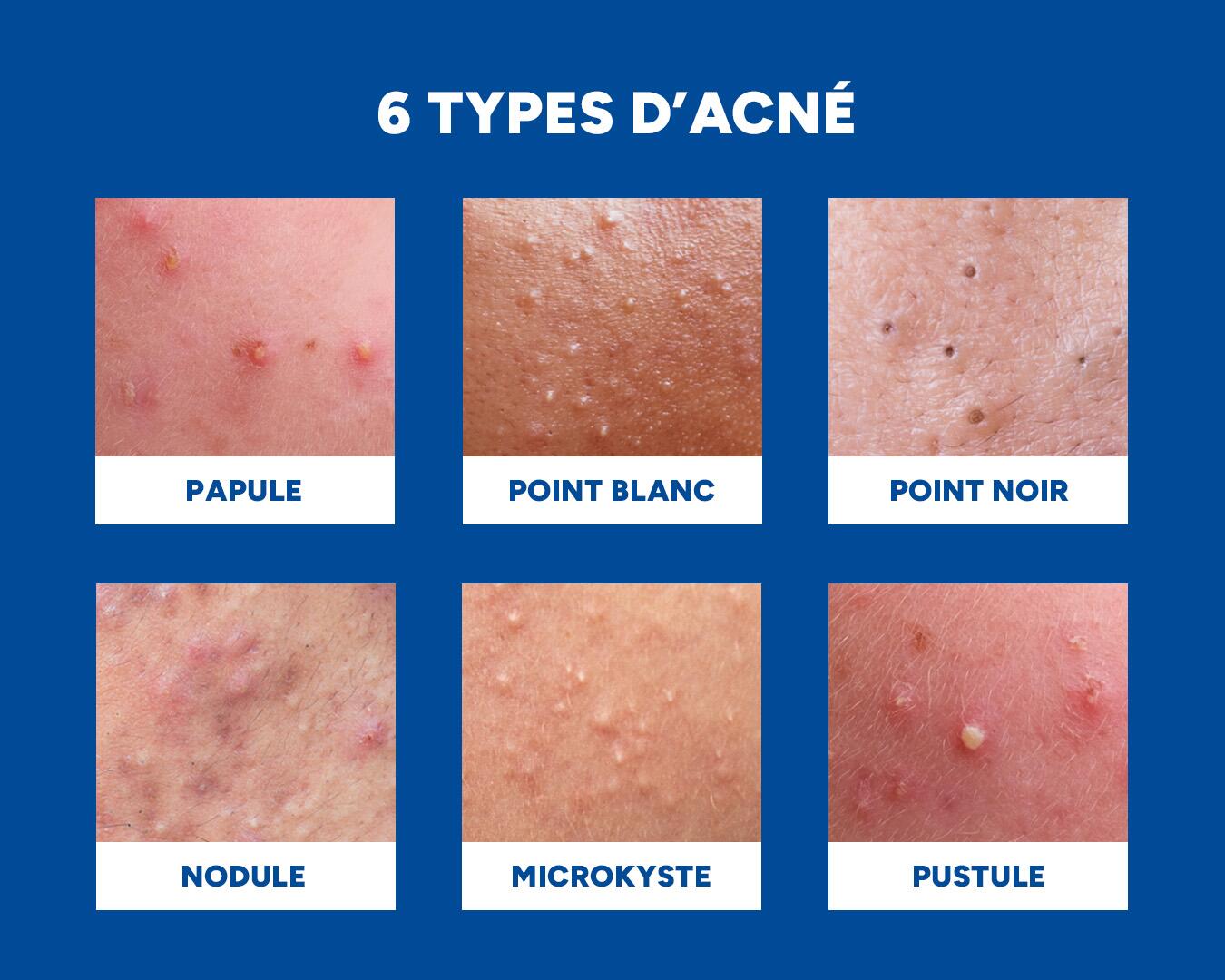 Photo des différents types de bouton liés à l’acné : papule, point blanc, point noir, nodule, microkyste et pustule